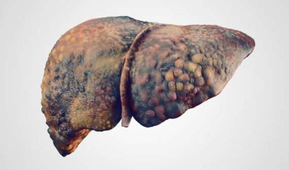Alcoholic Liver Disease Treatment in Pune | Alcoholic Liver