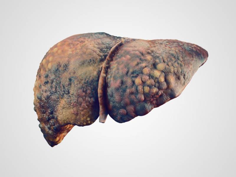 Alcoholic Liver Disease Treatment in Pune | Alcoholic Liver