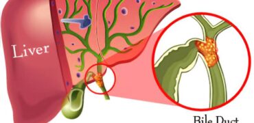 Bile Duct Cancer Treatment in Pune