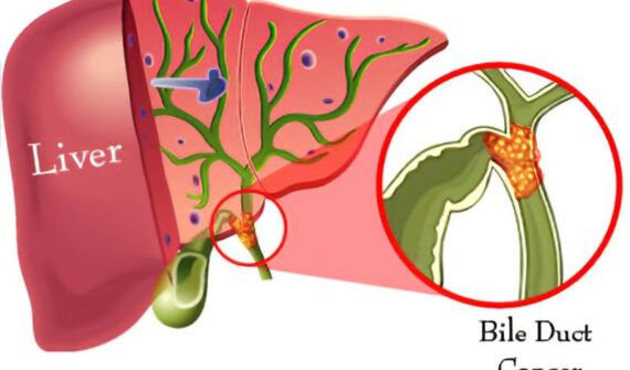 Bile Duct Cancer Treatment in Pune