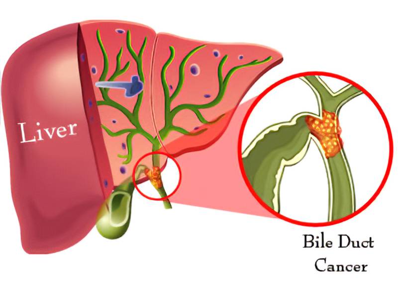 Bile Duct Cancer Treatment in Pune