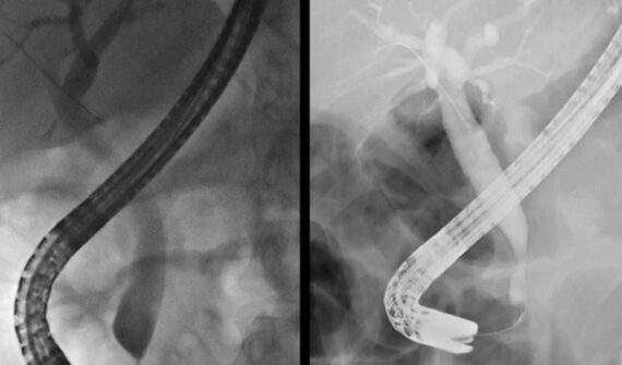 Biliary Stricture | Bile Duct Cancer Surgeon in Pune