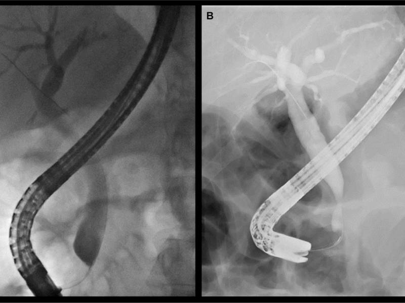 Biliary Stricture | Bile Duct Cancer Surgeon in Pune