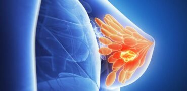 Breast Cancer specialist in Pune