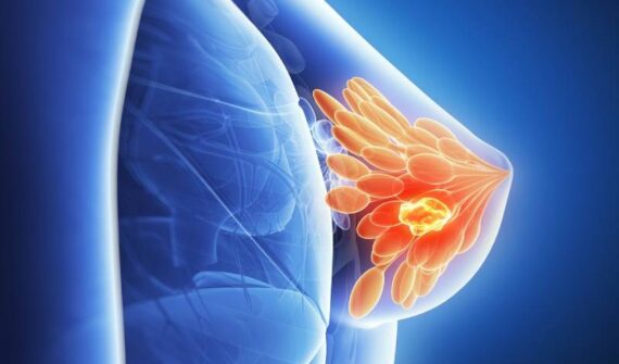 Breast Cancer Specialist in Pune