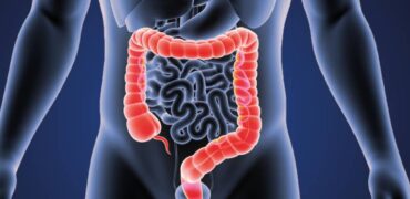 Colorectal Cancer