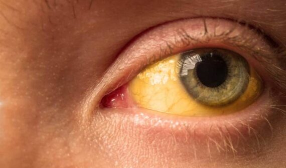 Jaundice Treatment in Pune | Liver Disease