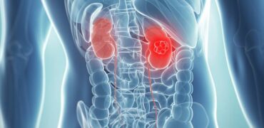Kidney Cancer Treatment - Dr. Manoj Dongare