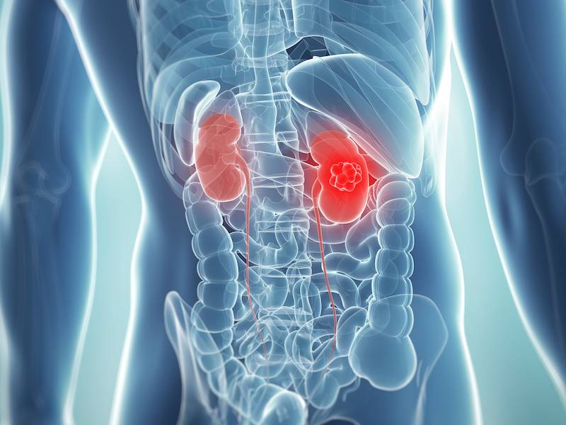 Kidney Cancer Treatment - Dr. Manoj Dongare