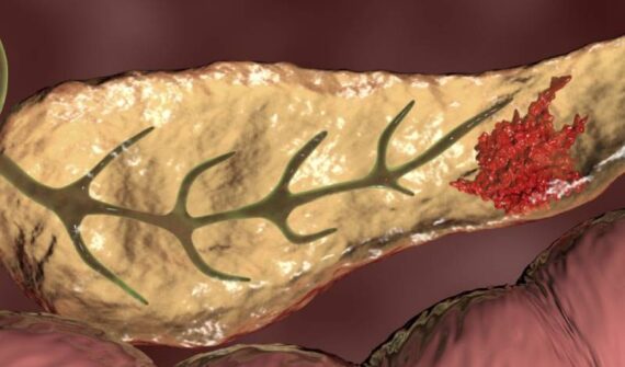 Pancreatic Cancer Treatment in Pune