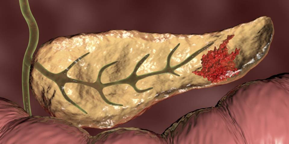 Understanding Pancreatic Cancers