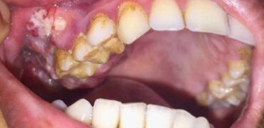 Oral cancer Specialist in Pune