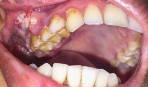 Oral cancer treatment in Pune | Oral Cancer Specialist in Pune | Mouth Cancer treatment: Dr. Manoj Dongare