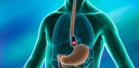 Esophageal Cancer