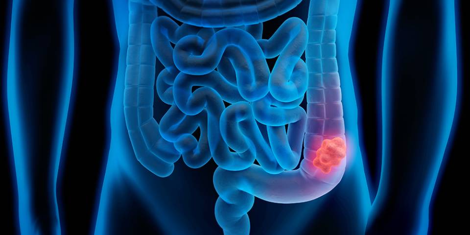 Colorectal Cancer