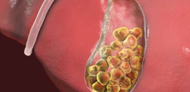 Illustration of gallbladder with multiple stones, related to Gallbladder Cancer Treatment in Pune.