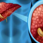 Image of Hydatid Cyst in the Liver: Diagnosis and Surgical Options