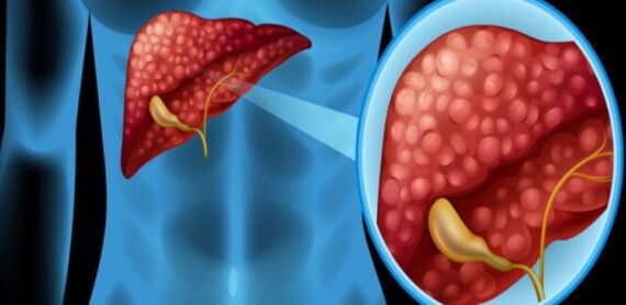 Image of Hydatid Cyst in the Liver: Diagnosis and Surgical Options