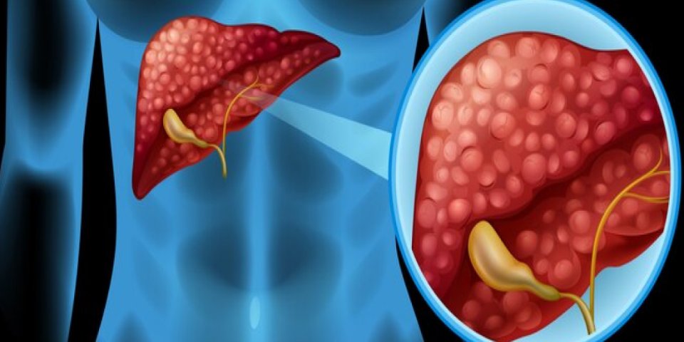 Image of Hydatid Cyst in the Liver: Diagnosis and Surgical Options