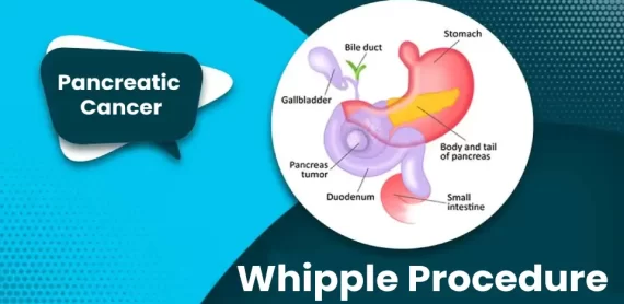 Medical illustration showing organs involved in the Whipple Procedure for Pancreatic Cancer.