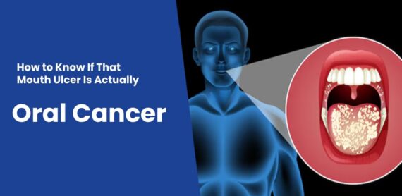 Illustration showing the difference between a normal mouth ulcer and signs of oral cancer – Mouth Ulcer or Oral Cancer awareness.