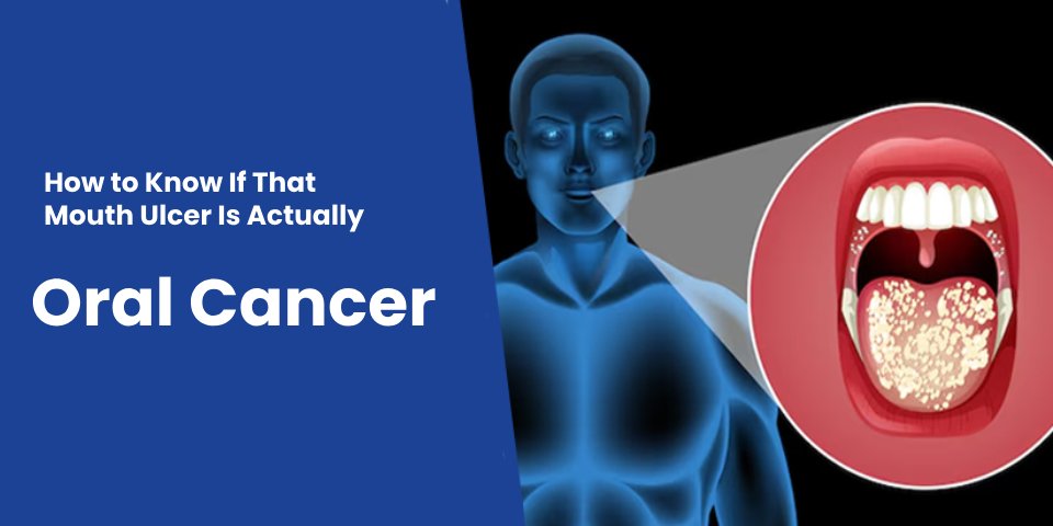 Illustration showing the difference between a normal mouth ulcer and signs of oral cancer – Mouth Ulcer or Oral Cancer awareness.