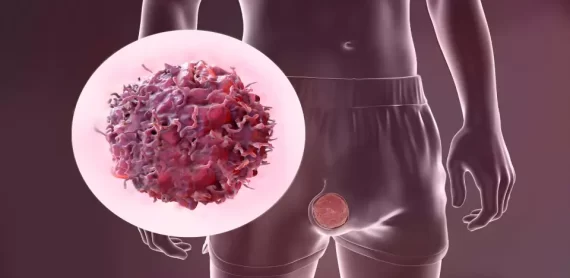 3D illustration showing a testicular cancer cell and male reproductive anatomy highlighting risk factors for testicular cancer.