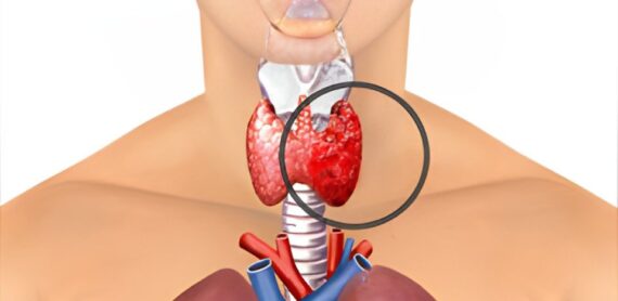Medical illustration showing thyroid gland highlighting a lump – Is That Neck Lump a Sign of Thyroid Cancer