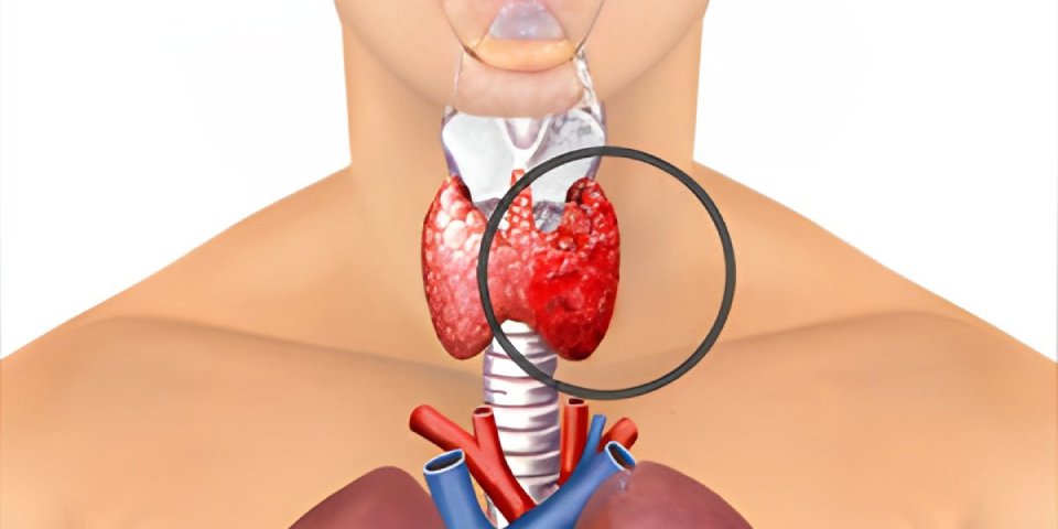 Medical illustration showing thyroid gland highlighting a lump – Is That Neck Lump a Sign of Thyroid Cancer