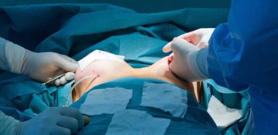 Surgical team performing reconstructive breast surgery after mastectomy in an operating room.