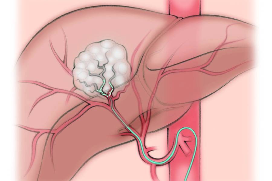 TACE Therapy in Pune – How Targeted Treatment Works for Liver Tumours Illustration showing how TACE Therapy in Pune targets liver tumours through a catheter delivering chemotherapy.