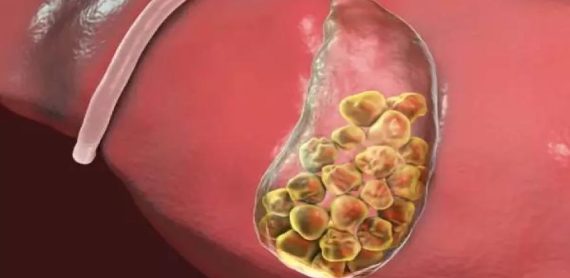Gallbladder Stone Surgery under MJPJAY Scheme for effective cholelithiasis removal and safe gallstones operation.