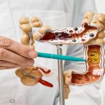 Medical model used to explain Partial Colectomy as a vital colon cancer surgery or colon resection.