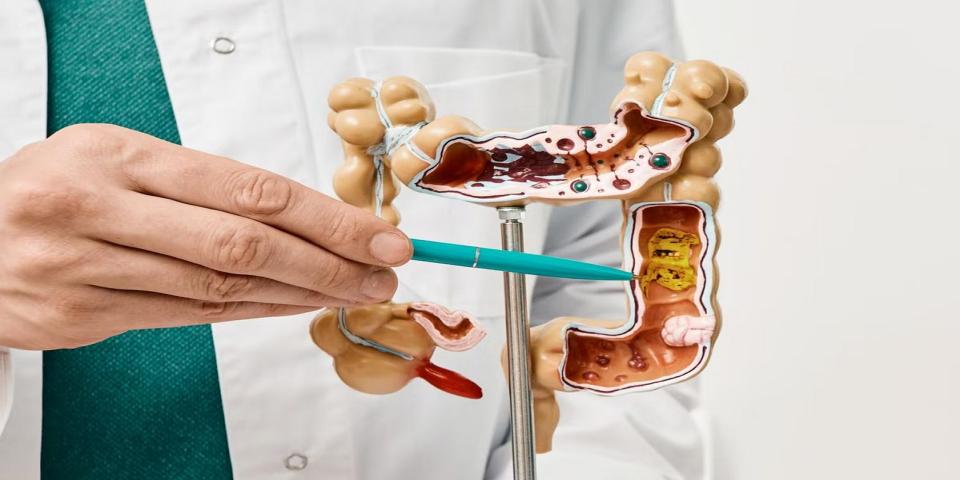Medical model used to explain Partial Colectomy as a vital colon cancer surgery or colon resection.