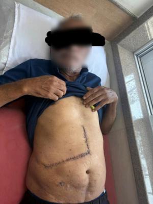 Liver Cancer Success Story