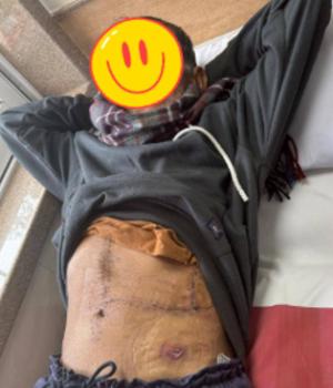 Successful Liver Cancer Surgery in a 69-Year-Old Patient 1
