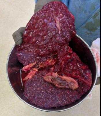 Successful Liver Transplant Saves a Brother's Life 1